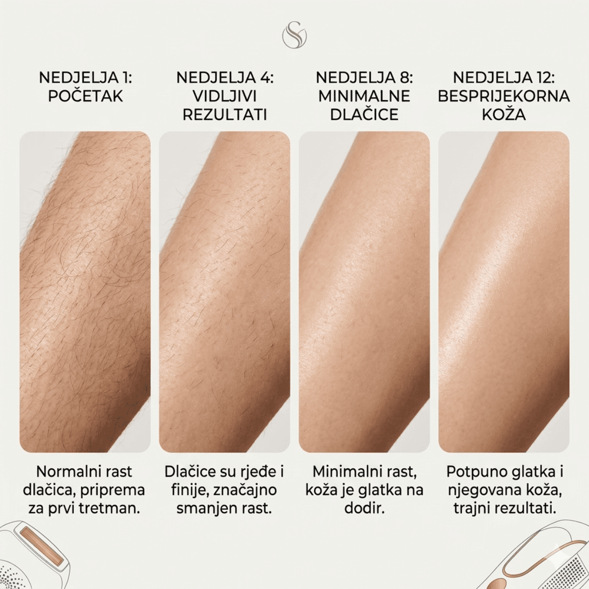 Priprema kože za ICE COOL LITE IPL tretman